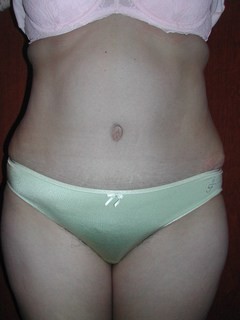 Tummy Tuck After Four Months