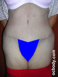 Tummy Tuck After 3 Months