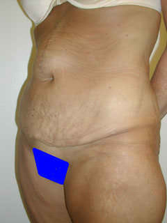 Before Tummy Tuck and Hernia Repair 1 Year After Weight Loss