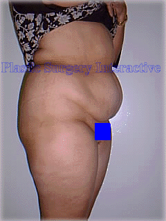One of Dr Di Saia's patient's before her Tummy Tuck operation
