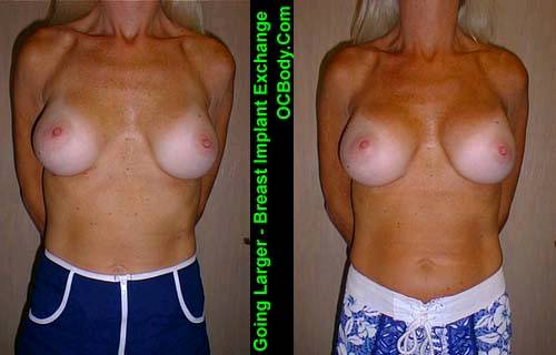 Before and Three Months after Breast Implant Exchange