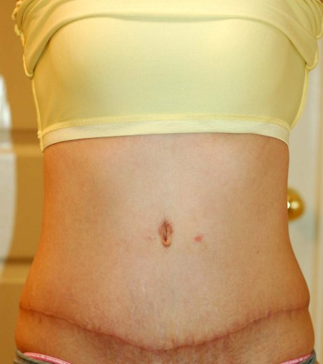 not so good tummy tuck belly button