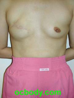 8 months after Mastectomy and Immediate Implant Reconstruction-stage I