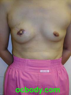 2 months after Nipple-Areolar Reconstruction- Stage II