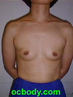 Prior to Mastectomy and Immediate Implant Reconstruction-stage I