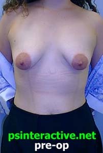 Before breast lift for tuberous breasts