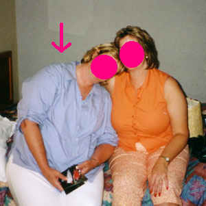 Before Gastric Bypass Procedure by Another Surgeon