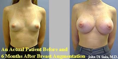 Before and Six Months after Breast Augmentation